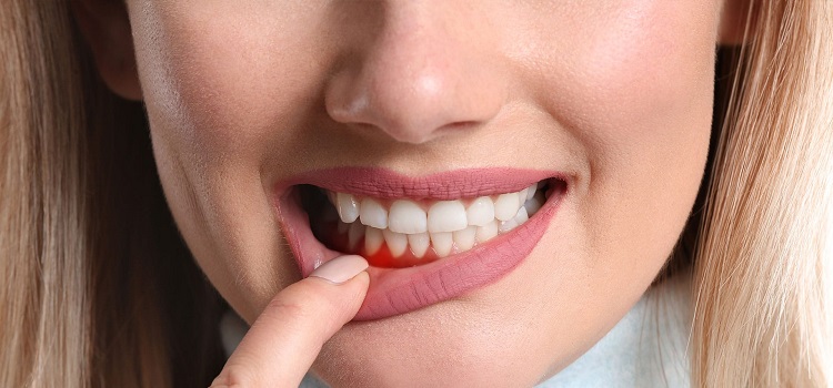 Spotting the Early Signs of Gum Disease